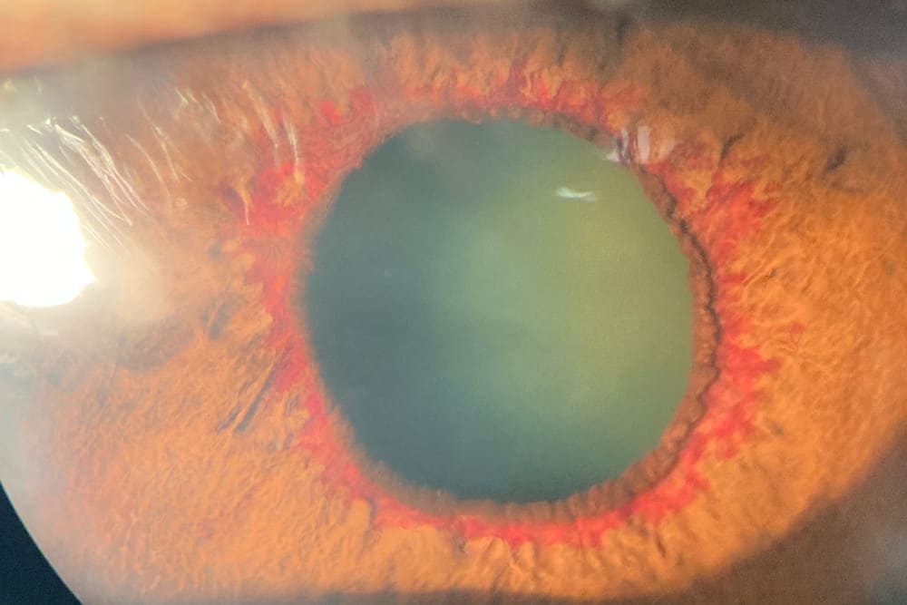 Retinopatía diabética