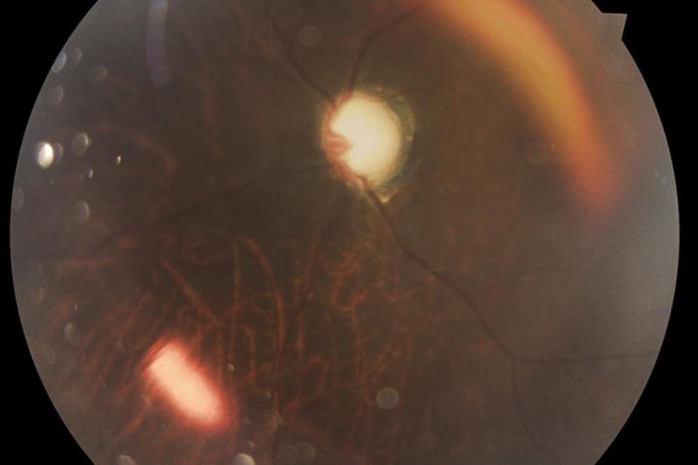 Glaucoma